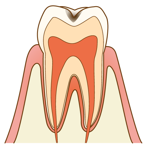 C1：エナメル質内の虫歯