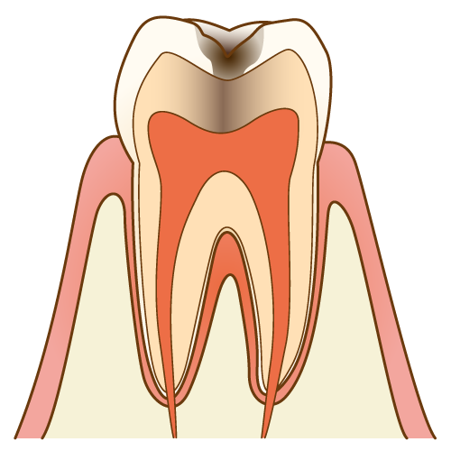 C2：象牙質に達した虫歯