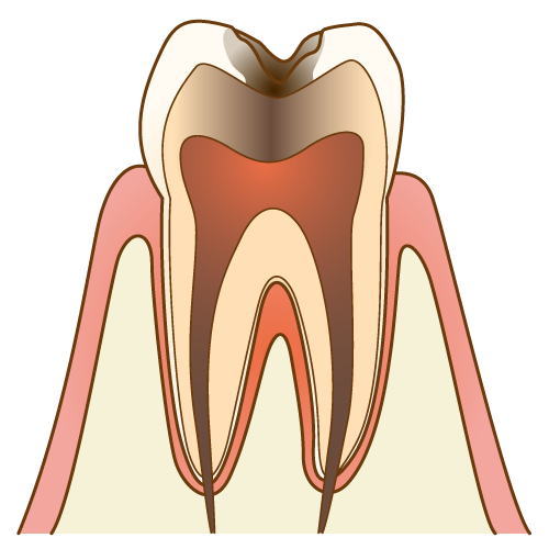 C3：歯髄(神経)に達した虫歯