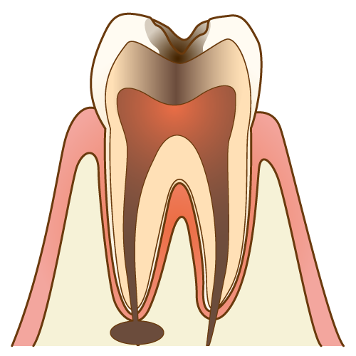 C4：歯質が失われた虫歯
