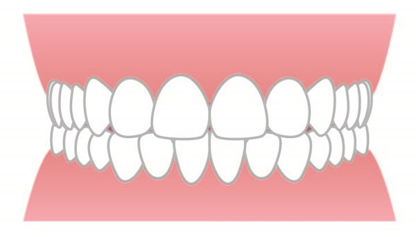 歯科矯正とは