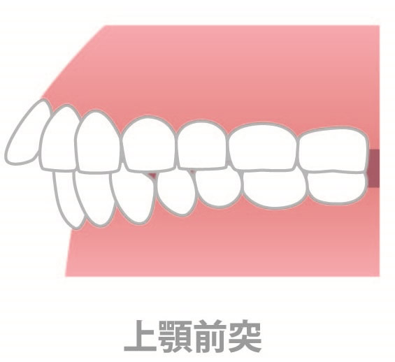 上顎前突（出っ歯）