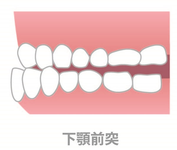 下顎前突（受け口）