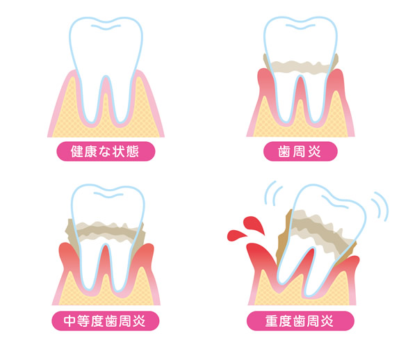 歯周病とは